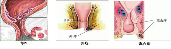 女性痔疮怎么检查